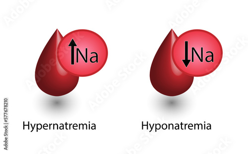 Hypernatremia, high plasma sodium level and Hyponatremia, low plasma sodium level. Sodium Na excess and deficit electrolyte disorders, blood test tube, Scientific design. Vector illustration.