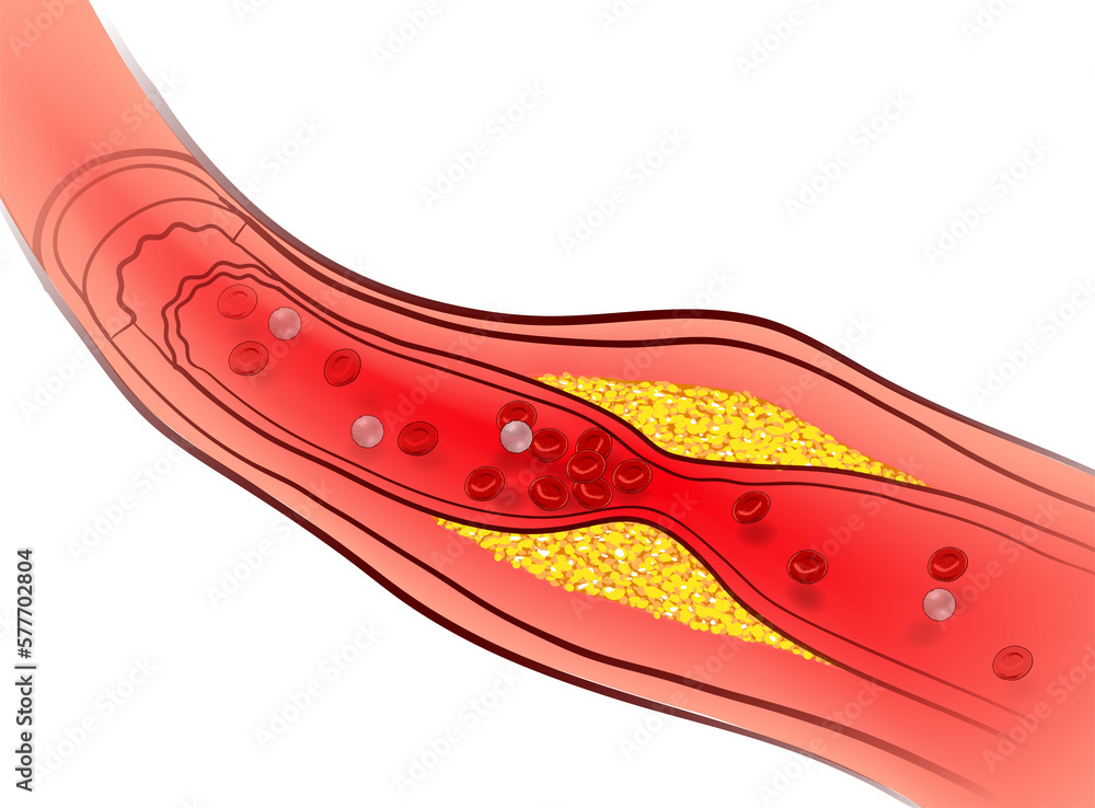 Arteries that are clogged with fat that causes blood clots are a