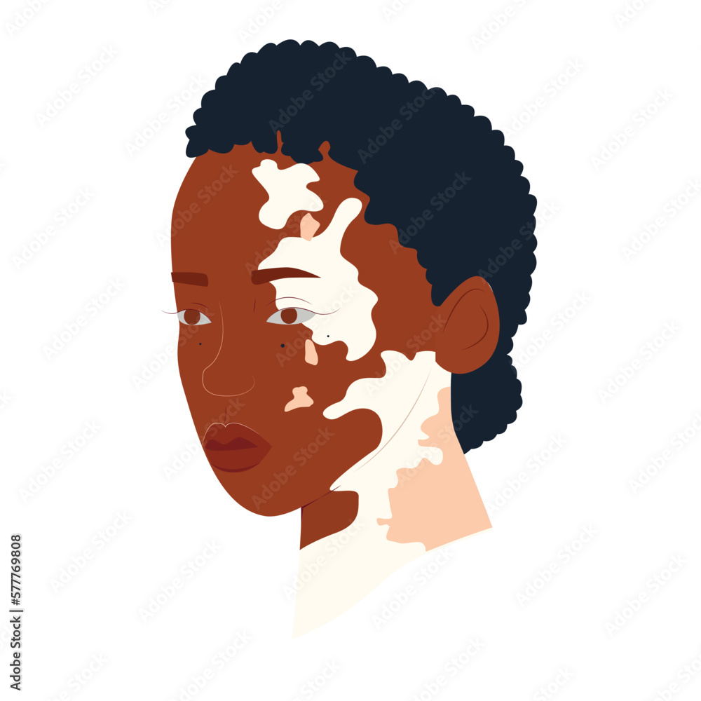 Vitiligo people isolated. Flat vector stock illustration. The concept of different beauty, body positive, self-acceptance.  women, vitiligo skin disease. Vitiligo skin illustration with people