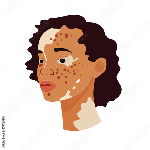 Vitiligo people isolated. Flat vector stock illustration. The concept of different beauty, body positive, self-acceptance.  women, vitiligo skin disease. Vitiligo skin illustration with people