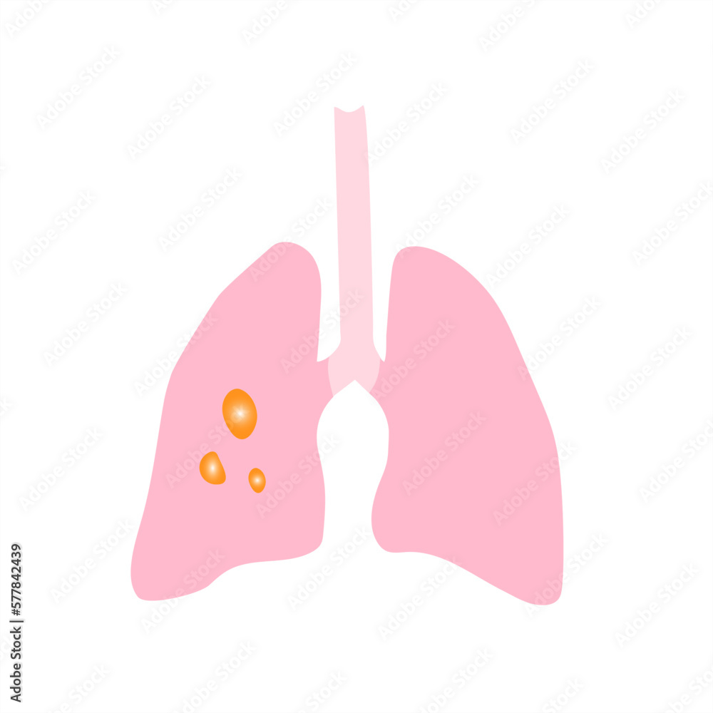Lung disease .Vector pattern of lungs with tumors or inflammation .Lung cancer Lung disease .Vector pattern of lungs with tumors or inflammation .Lung cancer
