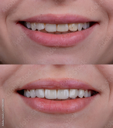 Before and after of smile makeover by dental ceramic veneer, porcelain laminate veneers on front teeth.