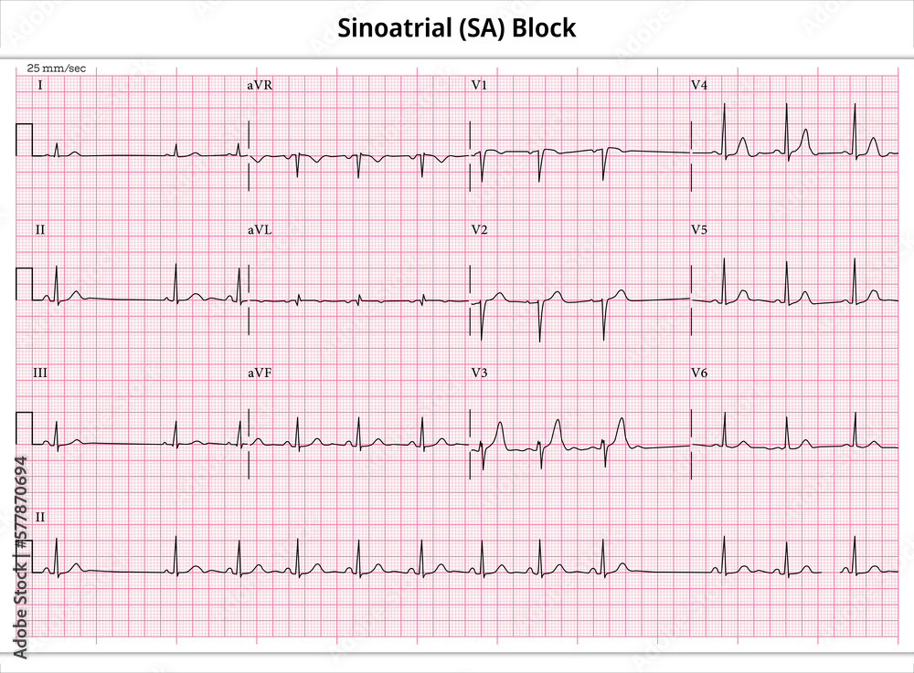 Sinoatrial (SA) Block ECG Paper 12 Lead Electrocardiogram Jpf