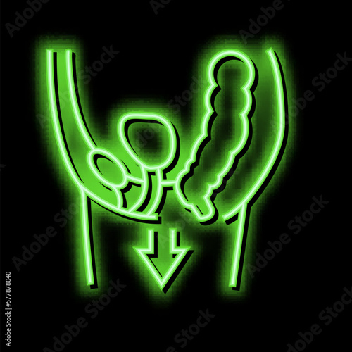 organ prolapse disease neon glow icon illustration
