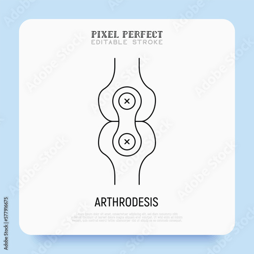 Arthrodesis joint surgery thin line icon. Arthritis. Pixel perfect, editable stroke. Vector illustration.