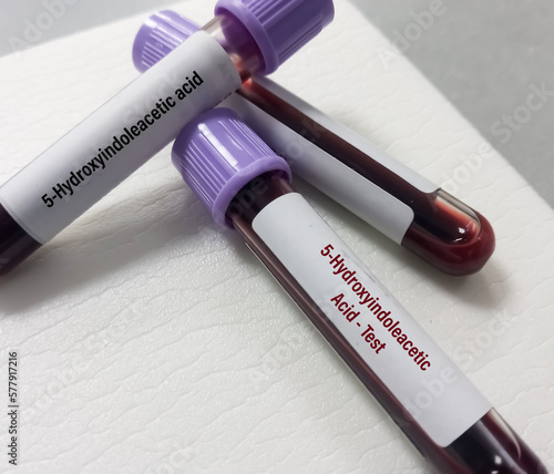 Blood sample for 5-HIAA (5-Hydroxyindoleacetic acid) test, used to help diagnose and monitor carcinoid tumors. Serotonin. Medical test. photo