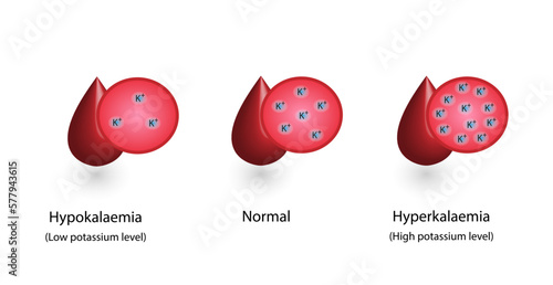 Hyperkalaemia, high plasma potassium level and Hypokalaemia, low plasma potassium level. Potassium K excess and deficit electrolyte disorders, blood test tube, Scientific design. Vector illustration.