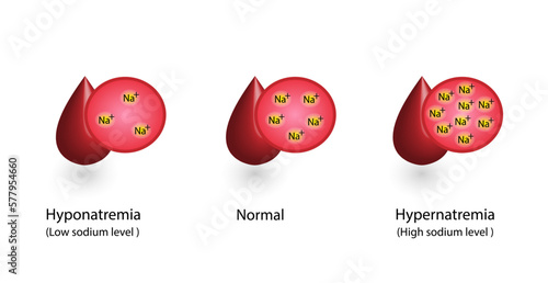 Hypernatremia, high plasma sodium level and Hyponatremia, low plasma sodium level. Sodium Na excess and deficit electrolyte disorders, blood test tube, Scientific design. Vector illustration.