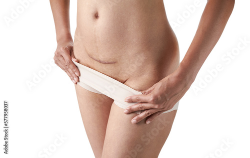 Closeup of woman belly with a scar from a cesarean section with her hands on white background