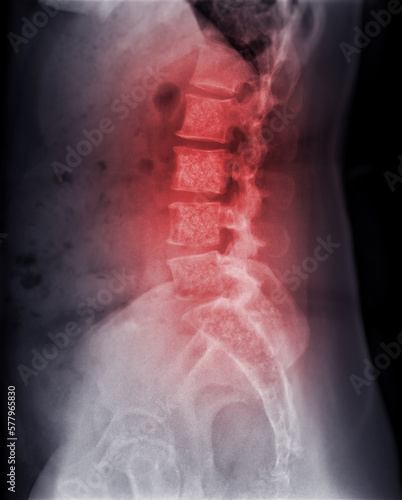 X-ray image of lambosacral spine or L-S spine showing Bone metastasis .