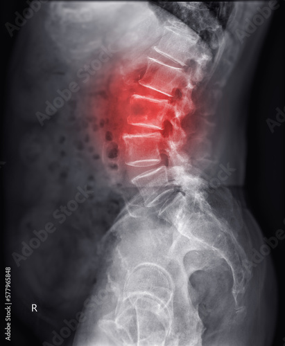 Foto X-ray image of lambosacral spine or L-S spine showing lesion at L3