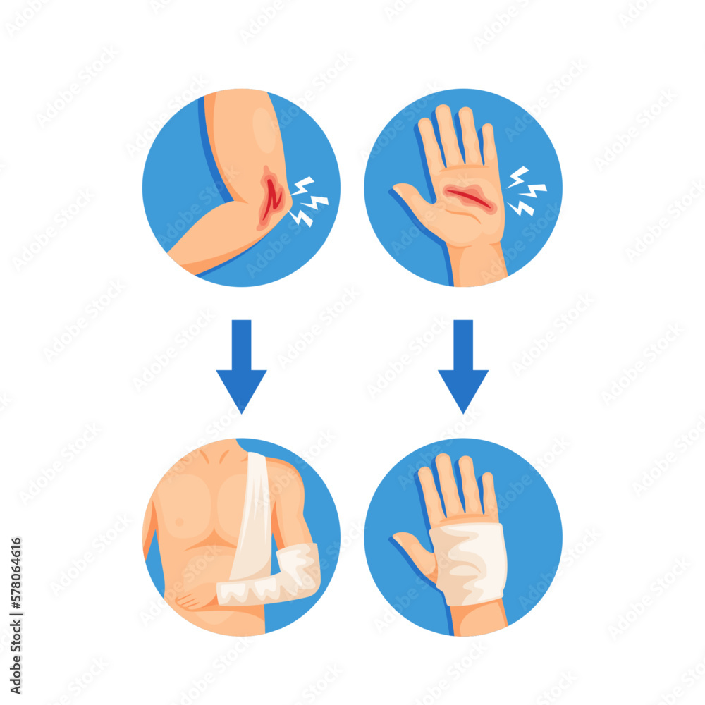 Process Of Injury Treatment And Bandaging, Infographics For Healthcare Or Medical-related Content. Hand With Wound Process Of Injury Treatment And Bandaging, Infographics For Healthcare Or Medical-related Content. Hand With Wound