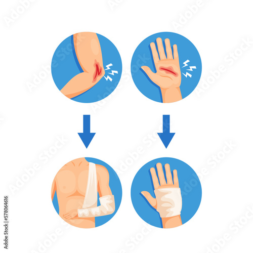 Process Of Injury Treatment And Bandaging, Infographics For Healthcare Or Medical-related Content. Hand With Wound