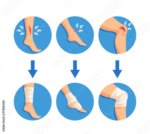 Leg Bandaging, Professional Wraps A Patient's Leg In A Specialized Bandage To Support Healing And Prevent Further Injury