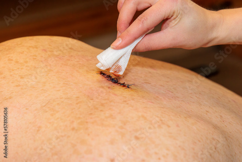 A hand cleans a double sutured scar from abscess surgery on a back with iodine and a swab photo