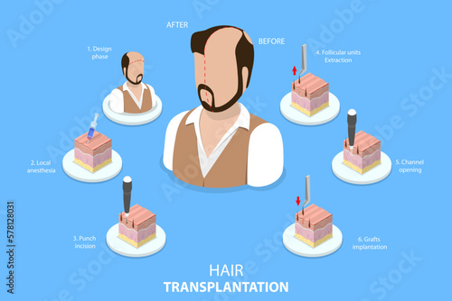 3D Isometric Flat Vector Conceptual Illustration of Hair Transplantation, Stages of FUE Procedure