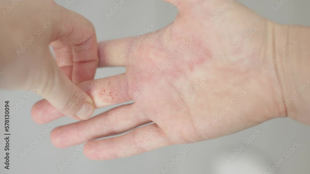 dermatitis hands palm skin itchy scratches on dry skin female hands, eczema psoriasis disease. itchy hurt atopic dermatitis symptoms of peeling epidermis on human palm. painful cracked skin illness dermatitis hands palm skin itchy scratches on dry skin female hands, eczema psoriasis disease. itchy hurt atopic dermatitis symptoms of peeling epidermis on human palm. painful cracked skin illness