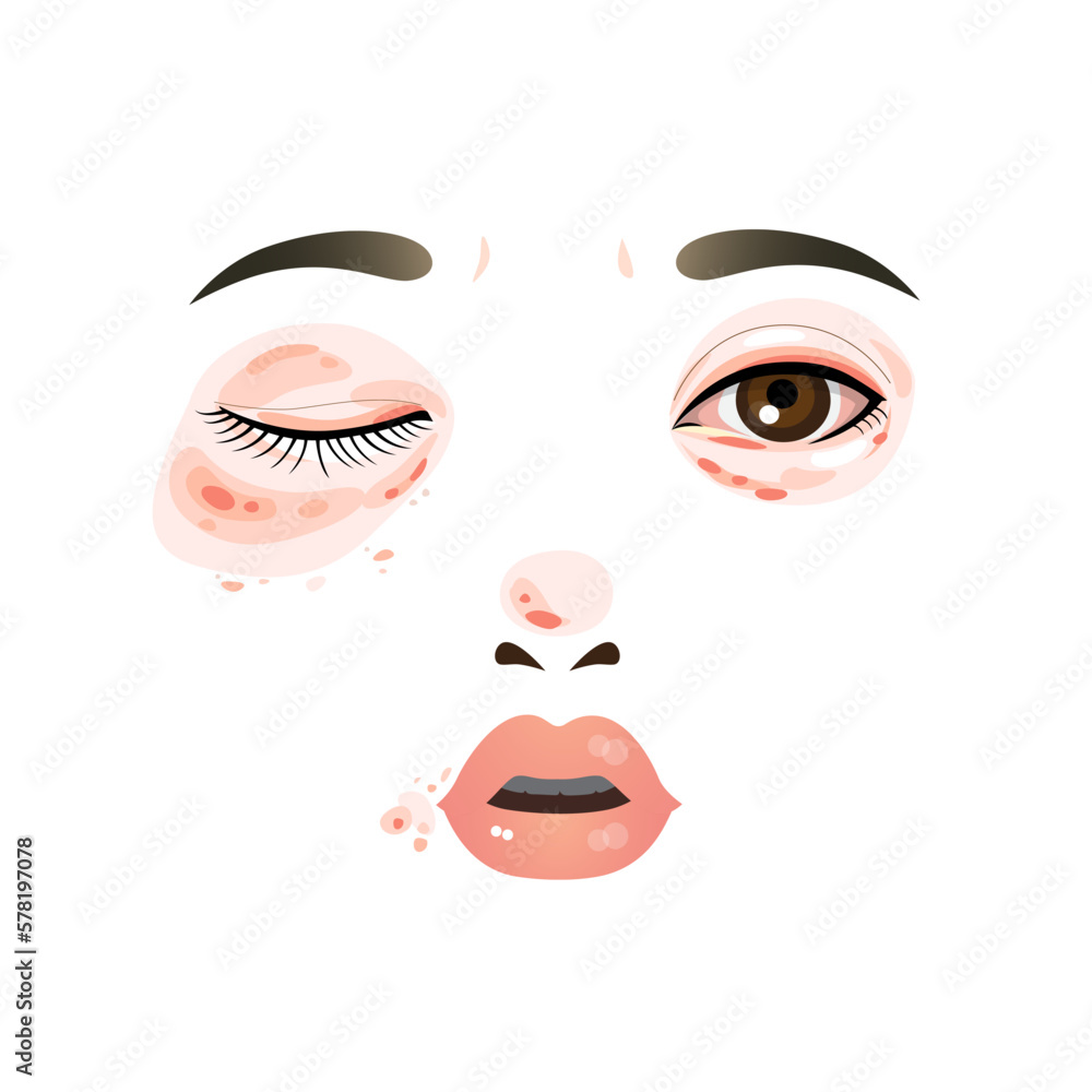 woman has allergic face woman has allergic face