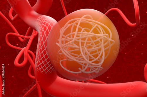 Aneurysm treat with mesh stent and coils - 3d illustration closeup view photo