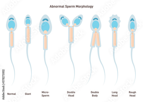 Sperm cell morphology. Normal, abnormal and defective human