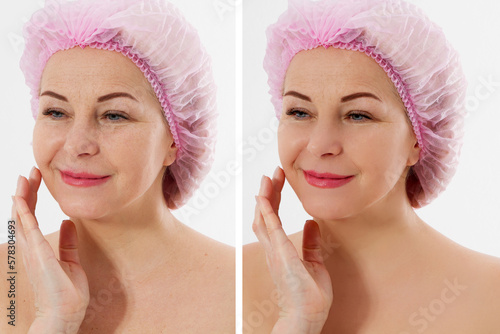 Closeup before after Beauty middle age woman face portrait. Before-after Spa anti wrinkled aging female body parts concept. Mid-aged Plastic surgery collagen face injections. Beauty Wrinkles menopause