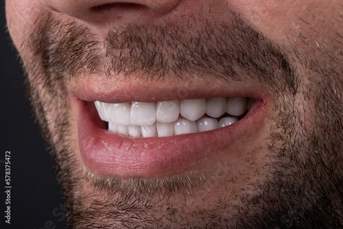 Valokuva Transform Your Smile with Veneers: Dentistry and Restorative Dental Solutions