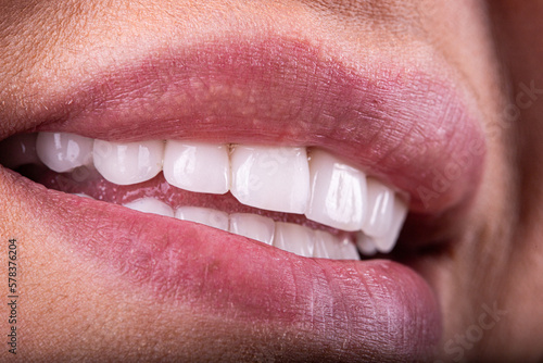 Transform Your Smile with Veneers: Dentistry and Restorative Dental Solutions