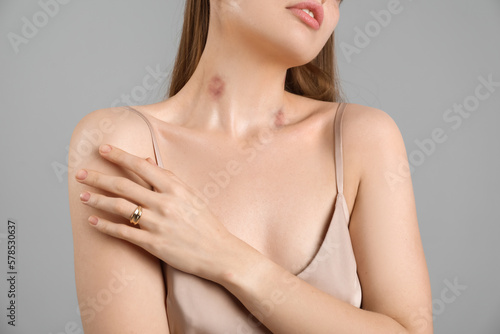 Beautiful woman with love bites on her neck against grey background, closeup