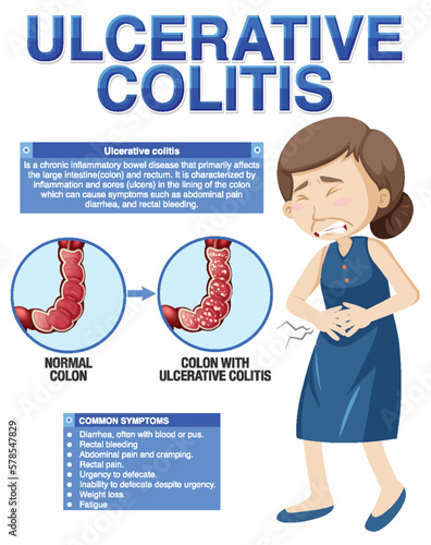 Ulcerative Colitis Symptoms Infographic