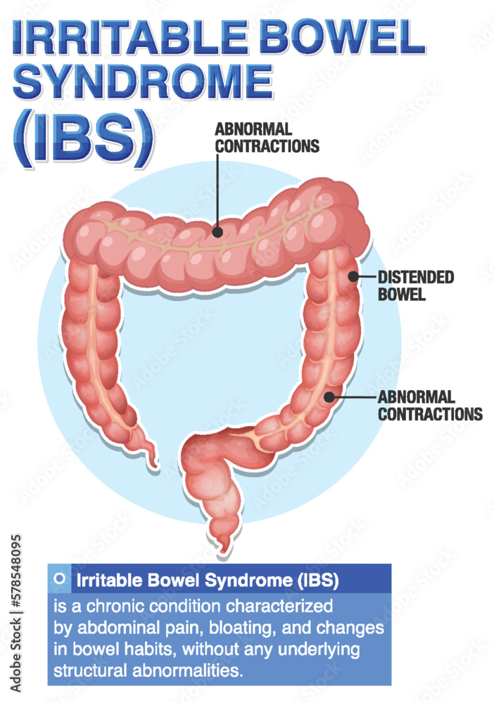 Image result for 10 Signs of Irritable Bowel Syndrome infographics