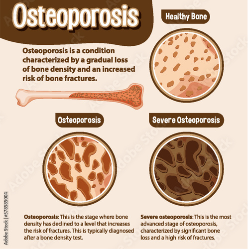 Informative poster of Osteoporosis human bone