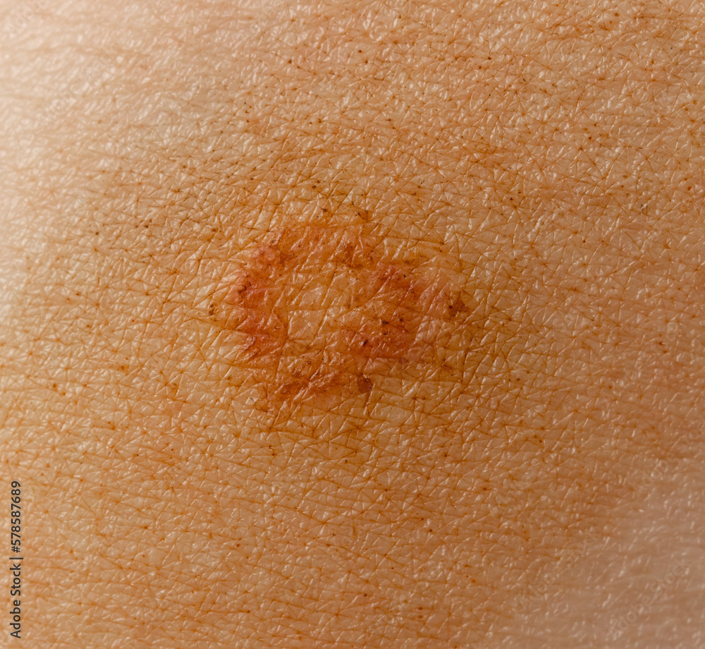 Fototapeta premium lichen on the skin as a background