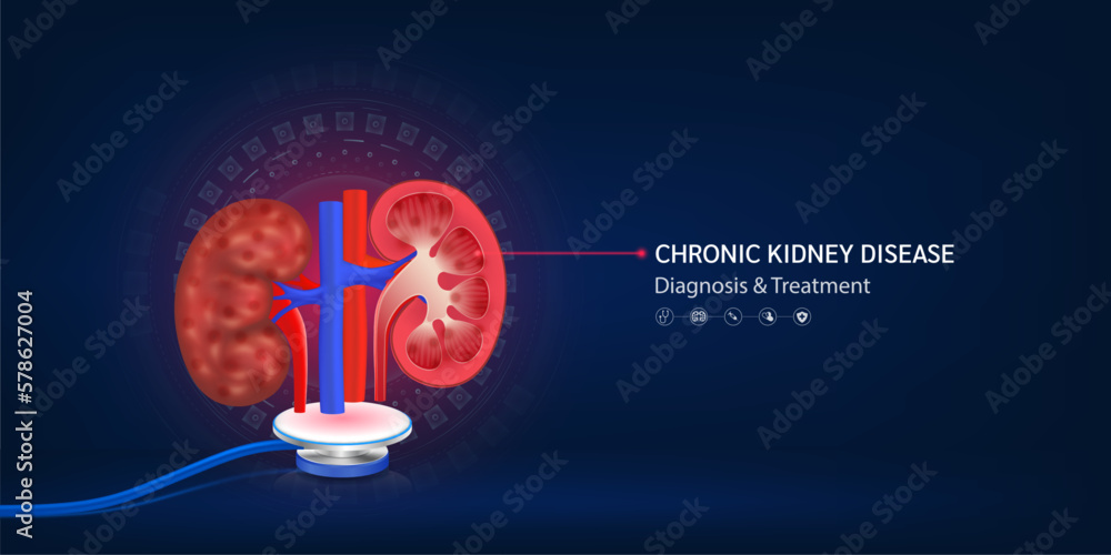 What Are Floating Kidneys at Juanita Peters blog