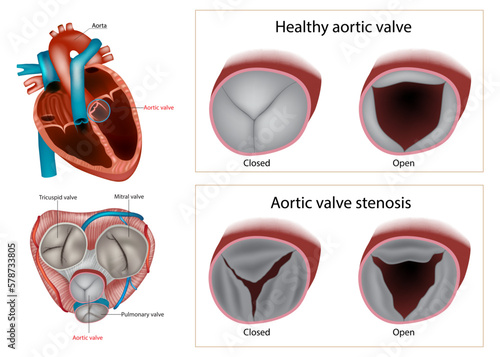 Healthy aortic valve or Aortic valve stenosis. Type of heart valve disease or valvular heart disease. Anatomy heart