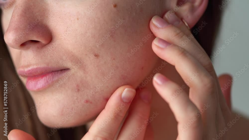 Young woman suffering from problem skin Young woman suffering from problem skin