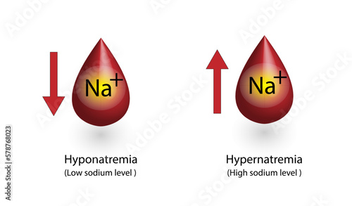 Hypernatremia, high plasma sodium level and Hyponatremia, low plasma sodium level. Sodium Na excess and deficit electrolyte disorders, blood test tube, Scientific design. Vector illustration.