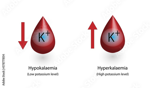 Hyperkalaemia, high plasma potassium level and Hypokalaemia, low plasma potassium level. Potassium K excess and deficit electrolyte disorders, blood test tube, Scientific design. Vector illustration.