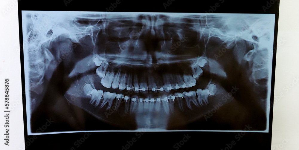 Xray of a denture with brackets. Xray of the mouth of an adolescent