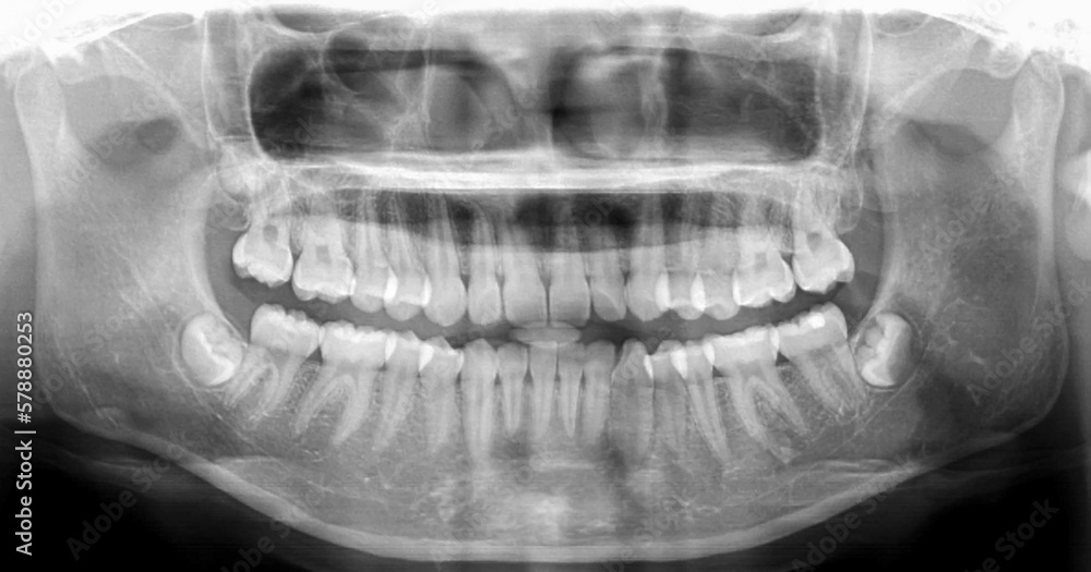 Panoramic dental Xray shows fixed teeth amalgam seal.Xray for dental