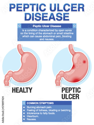 Peptic Ulcer Disease Explained Infographic