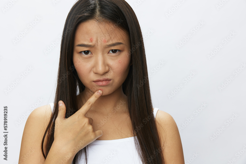 Asian woman facial skin problems, acne and inflammation, red rashes and allergies, chicken pox, sadness from rashes. Facial skin care concept for diseases and nerves Asian woman facial skin problems, acne and inflammation, red rashes and allergies, chicken pox, sadness from rashes. Facial skin care concept for diseases and nerves