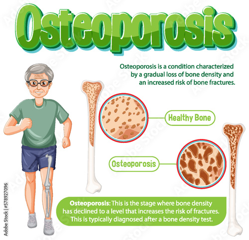 Informative poster of Osteoporosis human bone