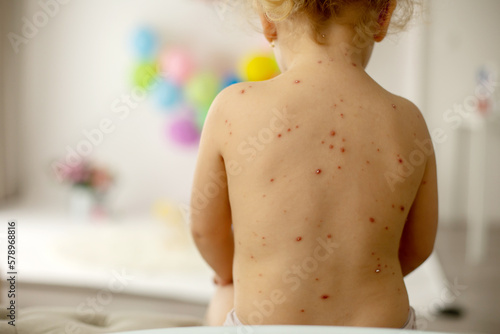Little toddler girl with chicken pox in bed, playing at home, quarantine isolation photo