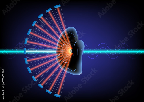 Focus ultrasound for treatment of neurological disease.