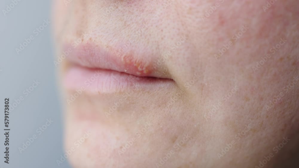 herpes sore on lips vesicles small bumps pimples blisters on upper lip female face. cold and flu sores. white and yellow red translucent bumps filled with clear liquid close-up. dermatology health herpes sore on lips vesicles small bumps pimples blisters on upper lip female face. cold and flu sores. white and yellow red translucent bumps filled with clear liquid close-up. dermatology health