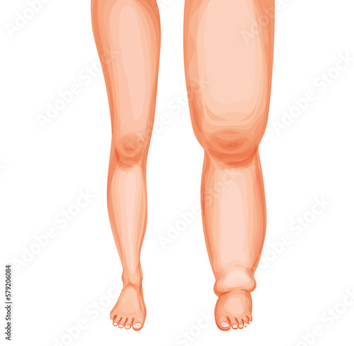 Edema foot. Swollen leg and ankle, vector lymphedema or lymphoedema disease of lymphatic system. Cartoon human feets comparison, healthy and swollen legs, fluid retention, lymph circulatory problems