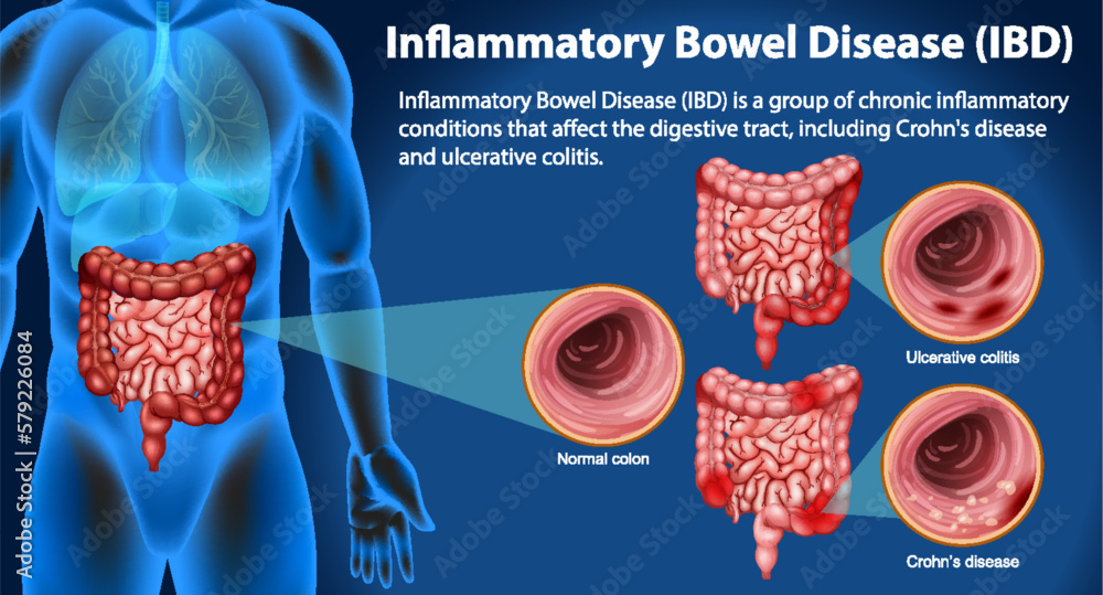 Ibd Types Infographic Inflammatory Bowel Disease (IBD) Infographic Stock Vector | Adobe Stock