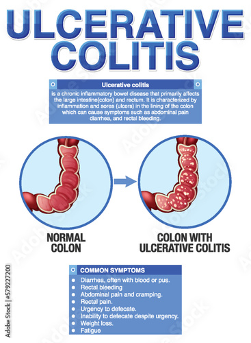 Ulcerative Colitis Symptoms Infographic
