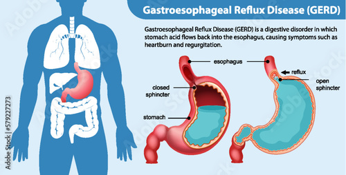 Gastroesophageal Reflux Disease (GERD) Diagram