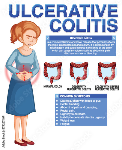 Ulcerative Colitis Symptoms Infographic
